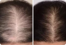 Before and After Louise